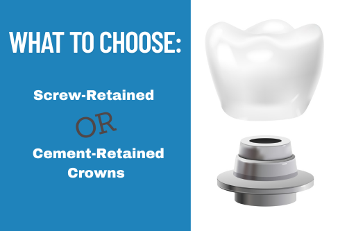 What to choose - screw retained or cement crowns feature image