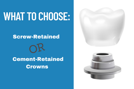 What to choose - screw retained or cement crowns feature image