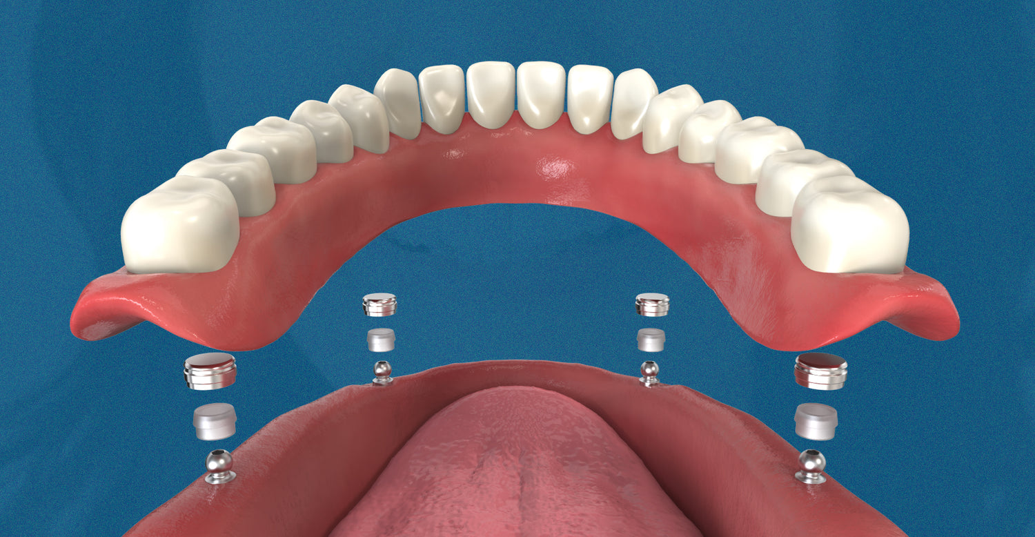 Accessories and Components for Overdenture Attachments